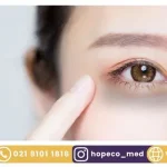 درمان سیاهی دور چشم با لیزر کیوسوییچ