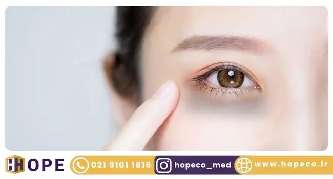 درمان سیاهی دور چشم با لیزر کیوسوییچ