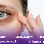 درمان سیاهی دور چشم با لیزر کیوسوییچ
