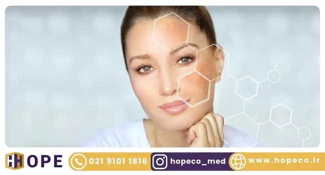 درمان لک صورت با لیزر کیوسوییچ