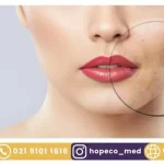 درمان منافذ باز پوست با لیزر co2 فرکشنال