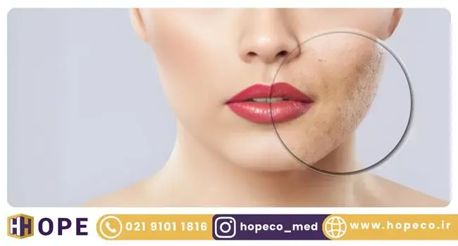 درمان منافذ باز پوست با لیزر co2 فرکشنال