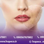 درمان منافذ باز پوست با لیزر co2 فرکشنال