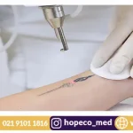 بهترین دستگاه پاک کننده تاتو