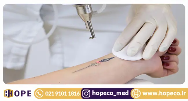 بهترین دستگاه پاک کننده تاتو